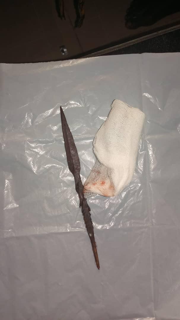 Some of the arrowheads removed from the victim's body.