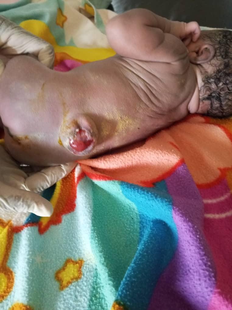 A baby born with Spina Bifida in Nyaravur-Angal town council, Nebbi district. Photo by Alex Pithua