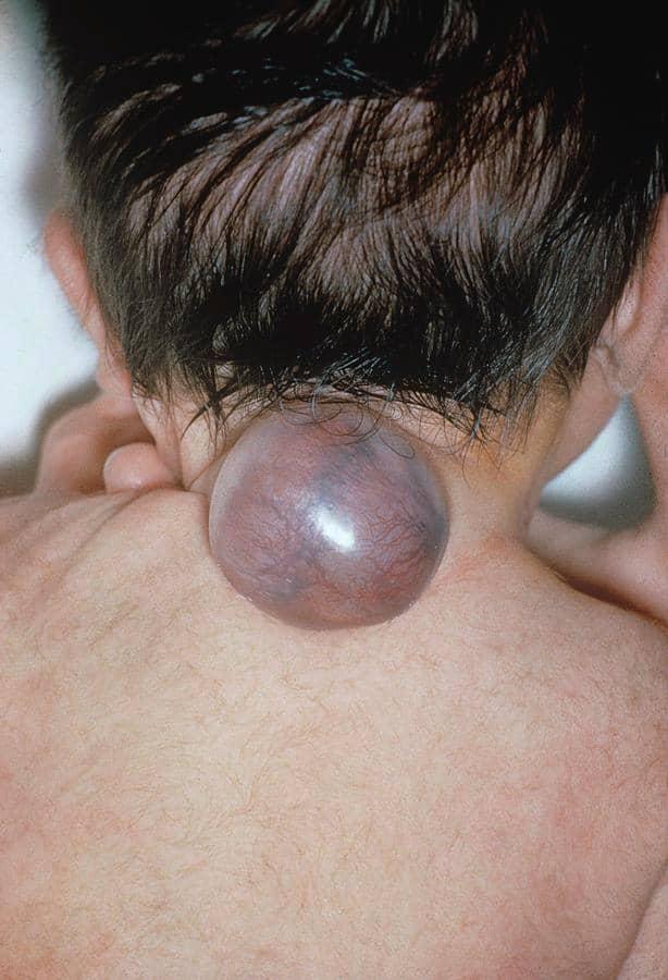West Nile, Acholi, and Lango Regions Face Over 900 Cases of Spina Bifida and Hydrocephalus